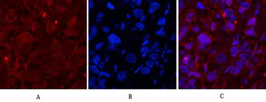 Fig.3. Immunofluorescence analysis of human breast cancer tissue. 1, Cleaved-Caspase-1 (D210) Polyclonal Antibody (red) was diluted at 1:200 (4°C, overnight). 2, Cy3 Labeled secondary antibody was diluted at 1:300 (room temperature, 50min). 3, Picture B: DAPI (blue) 10min. Picture A: Target. Picture B: DAPI. Picture C: merge of A+B.