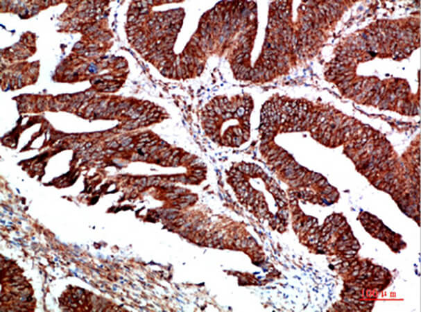 Fig.1. Immunohistochemical analysis of paraffin-embedded human colon cancer, antibody was diluted at 1:200.