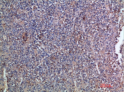 Fig.2. Immunohistochemical analysis of paraffin-embedded human-kidney-cancer, antibody was diluted at 1:200.
