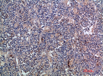 Fig.3. Immunohistochemical analysis of paraffin-embedded human-kidney-cancer, antibody was diluted at 1:200.