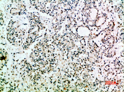 Fig.4. Immunohistochemical analysis of paraffin-embedded human-stomach-cancer, antibody was diluted at 1:200.