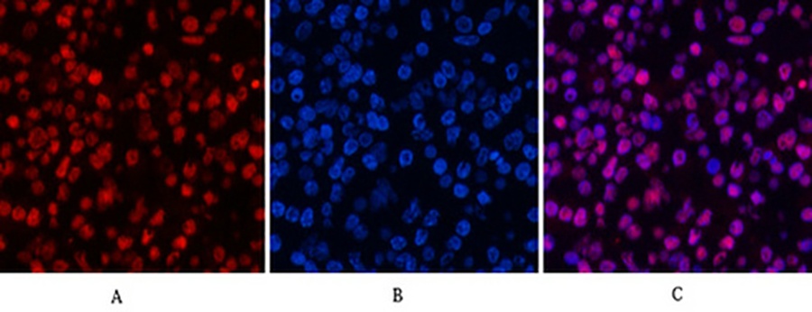 Fig.5. Immunofluorescence analysis of human lung cancer tissue. 1, Histone H3 (Acetyl Lys9) Polyclonal Antibody (red) was diluted at 1:200 (4°C, overnight). 2, Cy3 Labeled secondary antibody was diluted at 1:300 (room temperature, 50min). 3, Picture B: DAPI (blue) 10min. Picture A: Target. Picture B: DAPI. Picture C: merge of A+B.