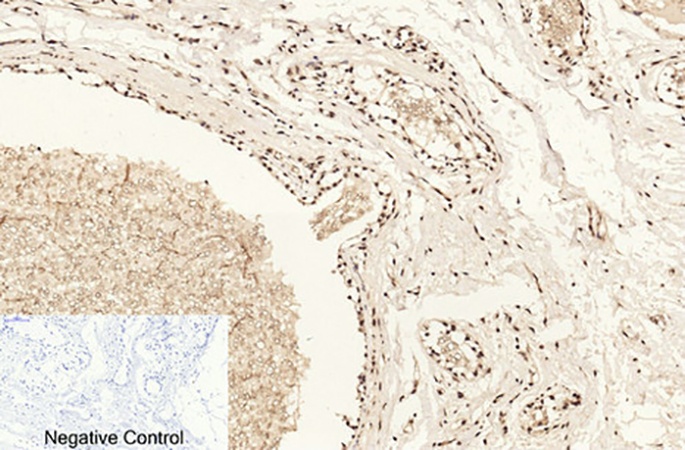 Fig.2. Immunohistochemical analysis of paraffin-embedded human breast tissue. 1, Histone H4 (Acetyl Lys16) Polyclonal Antibody was diluted at 1:200 (4°C, overnight). 2, Sodium citrate pH 6.0 was used for antibody retrieval (>98°C, 20min). 3, secondary antibody was diluted at 1:200 (room temperature, 30min). Negative control was used by secondary antibody only.