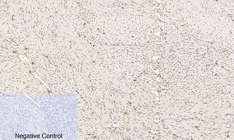 Fig.2. Immunohistochemical analysis of paraffin-embedded human uterus cancer tissue. 1, ERK 1/2 (phospho Thr202) Polyclonal Antibody was diluted at 1:200 (4°C, overnight). 2, Sodium citrate pH 6.0 was used for antibody retrieval (>98°C, 20min). 3, secondary antibody was diluted at 1:200 (room temperature, 30min). Negative control was used by secondary antibody only.