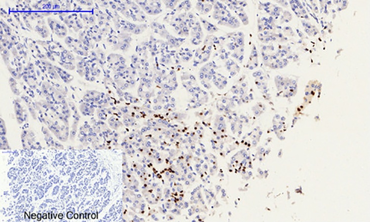 Fig.2. Immunohistochemical analysis of paraffin-embedded human stomach cancer tissue. 1, Histone H2A.X (phospho Ser139) Polyclonal Antibody was diluted at 1:200 (4°C, overnight). 2, Sodium citrate pH 6.0 was used for antibody retrieval (>98°C, 20min). 3, secondary antibody was diluted at 1:200 (room temperature, 30min). Negative control was used by secondary antibody only.