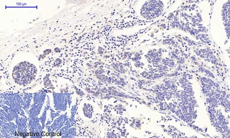 Fig.2. Immunohistochemical analysis of paraffin-embedded human lung cancer tissue. 1, p53 (phospho Thr18) Polyclonal Antibody was diluted at 1:200 (4°C, overnight). 2, Sodium citrate pH 6.0 was used for antibody retrieval (>98°C, 20min). 3, secondary antibody was diluted at 1:200 (room temperature, 30min). Negative control was used by secondary antibody only.