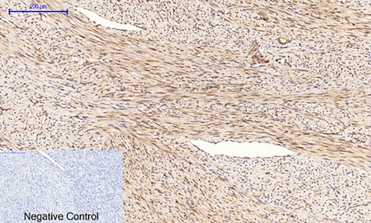 Fig.2. Immunohistochemical analysis of paraffin-embedded human uterus cancer tissue. 1, Tau (phospho Ser396) Polyclonal Antibody was diluted at 1:200 (4°C, overnight). 2, Sodium citrate pH 6.0 was used for antibody retrieval (>98°C, 20min). 3, secondary antibody was diluted at 1:200 (room temperature, 30min). Negative control was used by secondary antibody only.