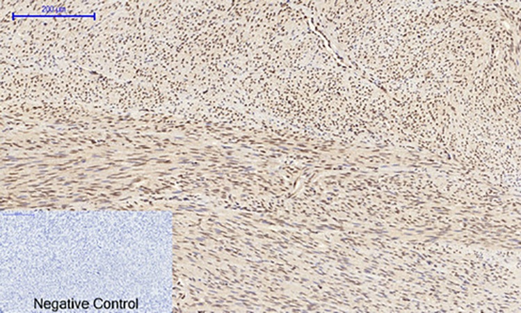 Fig.2. Immunohistochemical analysis of paraffin-embedded human uterus tissue. 1, JNK1/2/3 (phospho Tyr185) Polyclonal Antibody was diluted at 1:200 (4°C, overnight). 2, Sodium citrate pH 6.0 was used for antibody retrieval (>98°C, 20min). 3, secondary antibody was diluted at 1:200 (room temperature, 30min). Negative control was used by secondary antibody only.
