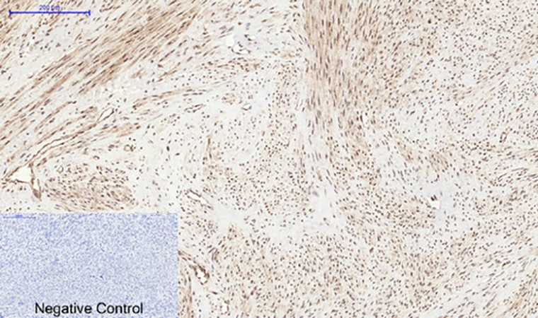 Fig.3. Immunohistochemical analysis of paraffin-embedded human uterus tissue. 1, PERK (phospho Thr981) Polyclonal Antibody was diluted at 1:200 (4°C, overnight). 2, Sodium citrate pH 6.0 was used for antibody retrieval (>98°C, 20min). 3, secondary antibody was diluted at 1:200 (room temperature, 30min). Negative control was used by secondary antibody only.
