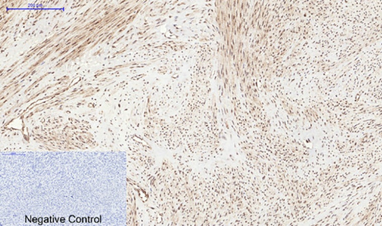 Fig.3. Immunohistochemical analysis of paraffin-embedded human uterus tissue. 1, PERK (phospho Thr981) Polyclonal Antibody was diluted at 1:200 (4°C, overnight). 2, Sodium citrate pH 6.0 was used for antibody retrieval (>98°C, 20min). 3, secondary antibody was diluted at 1:200 (room temperature, 30min). Negative control was used by secondary antibody only.