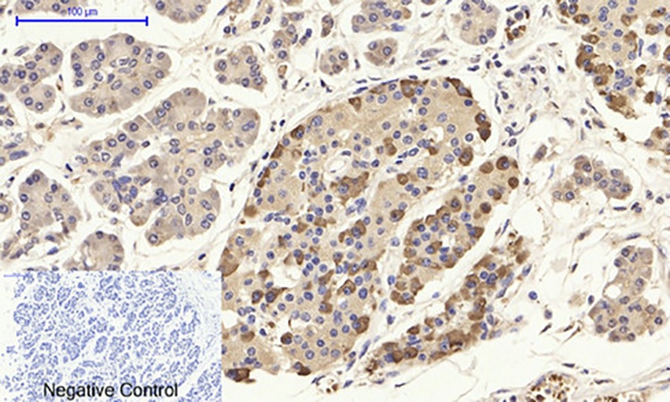 Fig.4. Immunohistochemical analysis of paraffin-embedded human stomach cancer tissue. 1, CD284 Polyclonal Antibody was diluted at 1:200 (4°C, overnight). 2, Sodium citrate pH 6.0 was used for antibody retrieval (>98°C, 20min). 3, secondary antibody was diluted at 1:200 (room temperature, 30min). Negative control was used by secondary antibody only.