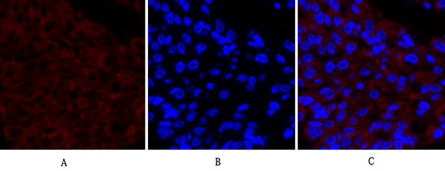 Fig.2. Immunofluorescence analysis of human liver cancer tissue. 1, Cox-2 Polyclonal Antibody (red) was diluted at 1:200 (4°C, overnight). 2, Cy3 labeled secondary antibody was diluted at 1:300 (room temperature, 50min). 3, Picture B: DAPI (blue) 10min. Picture A: Target. Picture B: DAPI. Picture C: merge of A+B.