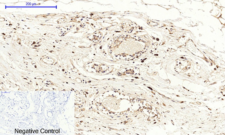 Fig.3. Immunohistochemical analysis of paraffin-embedded human breast tissue. 1, Cox-2 Polyclonal Antibody was diluted at 1:200 (4°C, overnight). 2, Sodium citrate pH 6.0 was used for antibody retrieval (>98°C, 20min). 3, secondary antibody was diluted at 1:200 (room temperature, 30min). Negative control was used by secondary antibody only.