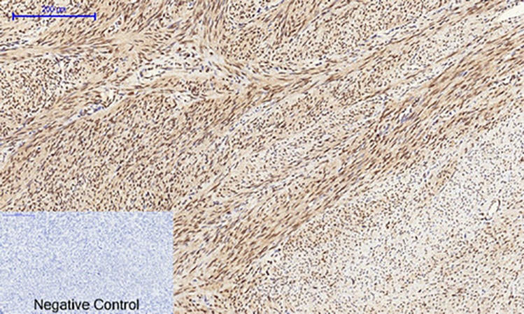 Fig.4. Immunohistochemical analysis of paraffin-embedded human uterus tissue. 1, CREB-1 Polyclonal Antibody was diluted at 1:200 (4°C, overnight). 2, Sodium citrate pH 6.0 was used for antibody retrieval (>98°C, 20min). 3, secondary antibody was diluted at 1:200 (room temperature, 30min). Negative control was used by secondary antibody only.