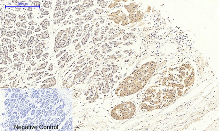 Fig.4. Immunohistochemical analysis of paraffin-embedded human stomach cancer tissue. 1, DRP1 Polyclonal Antibody was diluted at 1:200 (4°C, overnight). 2, Sodium citrate pH 6.0 was used for antibody retrieval (>98°C, 20min). 3, secondary antibody was diluted at 1:200 (room temperature, 30min). Negative control was used by secondary antibody only.