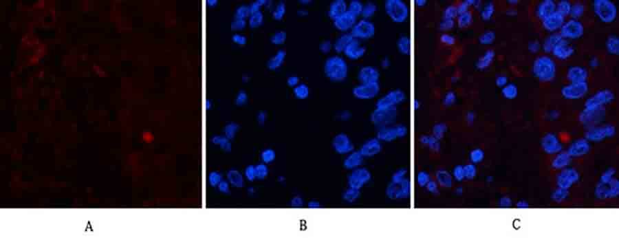 Fig.2. Immunofluorescence analysis of human liver cancer tissue. 1, FAS Polyclonal Antibody (red) was diluted at 1:200 (4°C, overnight). 2, Cy3 Labeled secondary antibody was diluted at 1:300 (room temperature, 50min). 3, Picture B: DAPI (blue) 10min. Picture A: Target. Picture B: DAPI. Picture C: merge of A+B.