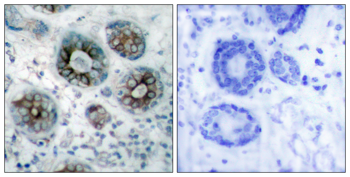 Fig.2. Immunohistochemistry analysis of paraffin-embedded human breast carcinoma tissue, using GAP43 Antibody. The picture on the right is blocked with the synthesized peptide.