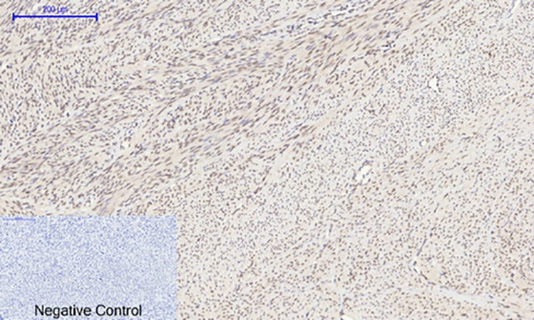 Fig.4. Immunohistochemical analysis of paraffin-embedded human uterus tissue. 1, HIF-1α Polyclonal Antibody was diluted at 1:200 (4°C, overnight). 2, Sodium citrate pH 6.0 was used for antibody retrieval (>98°C, 20min). 3, secondary antibody was diluted at 1:200 (room temperature, 30min). Negative control was used by secondary antibody only.
