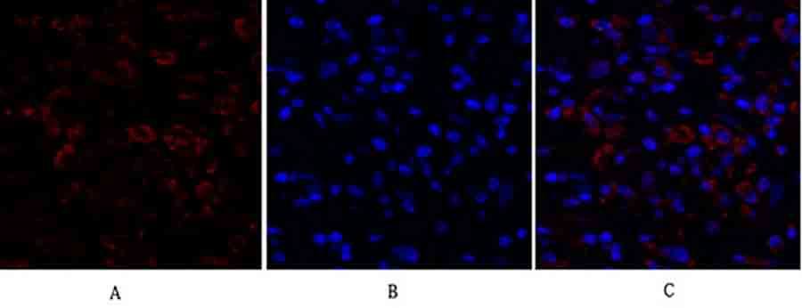 Fig.2. Immunofluorescence analysis of human breast cancer tissue. 1, Ki-67 Polyclonal Antibody (red) was diluted at 1:200 (4°C, overnight). 2, Cy3 Labeled secondary antibody was diluted at 1:300 (room temperature, 50min). 3, Picture B: DAPI (blue) 10min. Picture A: Target. Picture B: DAPI. Picture C: merge of A+B.
