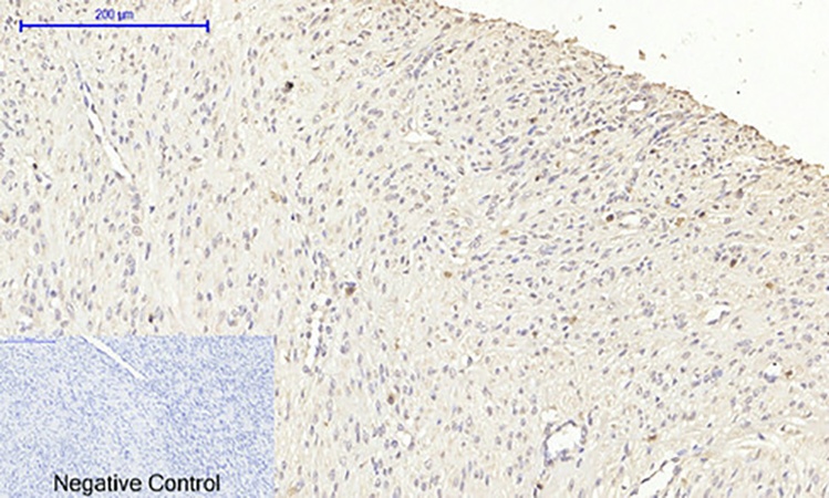 Fig.4. Immunohistochemical analysis of paraffin-embedded human uterus cancer tissue. 1, NOS2 Polyclonal Antibody was diluted at 1:200 (4°C, overnight). 2, Sodium citrate pH 6.0 was used for antibody retrieval (>98°C, 20min). 3, secondary antibody was diluted at 1:200 (room temperature, 30min). Negative control was used by secondary antibody only.