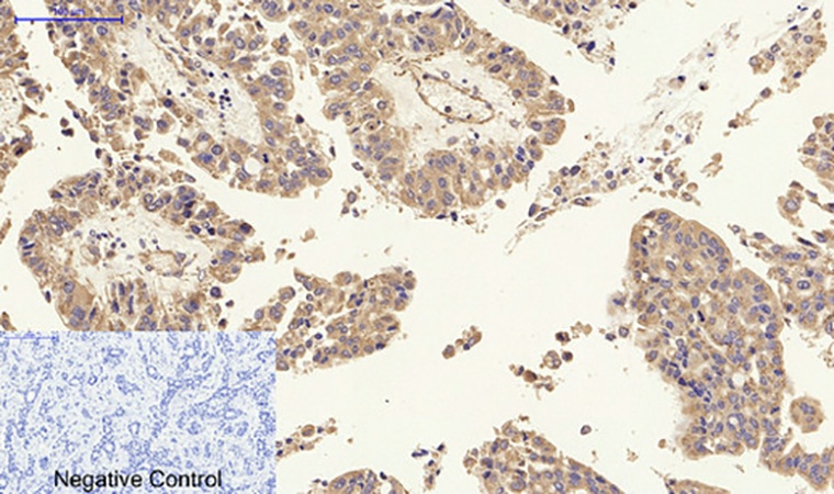 Fig.2. Immunohistochemical analysis of paraffin-embedded human liver cancer tissue. 1, p27 Polyclonal Antibody was diluted at 1:200 (4°C, overnight). 2, Sodium citrate pH 6.0 was used for antibody retrieval (>98°C, 20min). 3, secondary antibody was diluted at 1:200 (room temperature, 30min). Negative control was used by secondary antibody only.