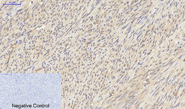 Fig.3. Immunohistochemical analysis of paraffin-embedded human uterus tissue. 1, PKM2 Polyclonal Antibody was diluted at 1:200 (4°C, overnight). 2, Sodium citrate pH 6.0 was used for antibody retrieval (>98°C, 20min). 3, secondary antibody was diluted at 1:200 (room temperature, 30min). Negative control was used by secondary antibody only.