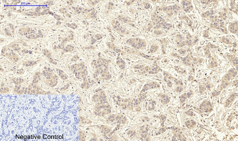 Fig.5. Immunohistochemical analysis of paraffin-embedded human liver cancer tissue. 1, Tak1 Polyclonal Antibody was diluted at 1:200 (4°C, overnight). 2, Sodium citrate pH 6.0 was used for antibody retrieval (>98°C, 20min). 3, secondary antibody was diluted at 1:200 (room temperature, 30min). Negative control was used by secondary antibody only.