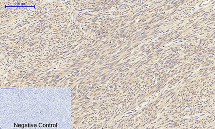 Fig.4. Immunohistochemical analysis of paraffin-embedded human uterus tissue. 1, TGFβ1 Polyclonal Antibody was diluted at 1:200 (4°C, overnight). 2, Sodium citrate pH 6.0 was used for antibody retrieval (>98°C, 20min). 3, secondary antibody was diluted at 1:200 (room temperature, 30min). Negative control was used by secondary antibody only.