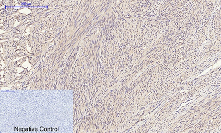Fig.4. Immunohistochemical analysis of paraffin-embedded human uterus tissue. 1, TIMP-1 Polyclonal Antibody was diluted at 1:200 (4°C, overnight). 2, Sodium citrate pH 6.0 was used for antibody retrieval (>98°C, 20min). 3, secondary antibody was diluted at 1:200 (room temperature, 30min). Negative control was used by secondary antibody only.