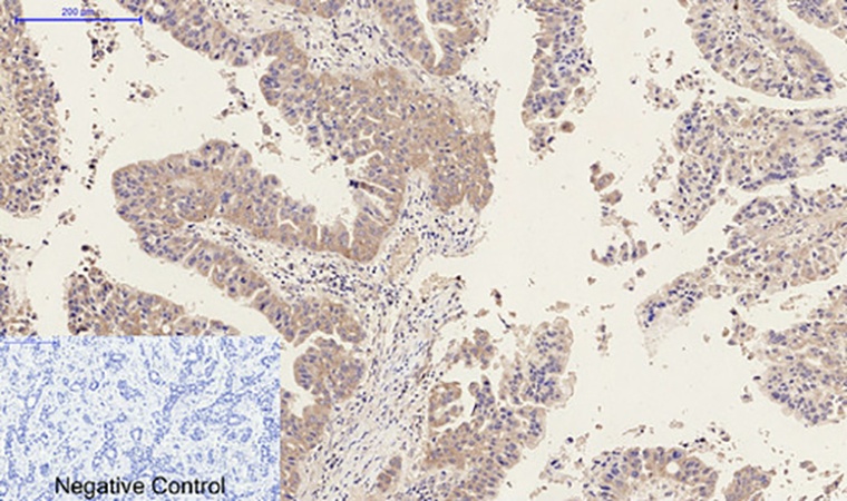 Fig.3. Immunohistochemical analysis of paraffin-embedded human liver cancer tissue. 1, MMP-9 Polyclonal Antibody was diluted at 1:200 (4°C, overnight). 2, Sodium citrate pH 6.0 was used for antibody retrieval (>98°C, 20min). 3, secondary antibody was diluted at 1:200 (room temperature, 30min). Negative control was used by secondary antibody only.