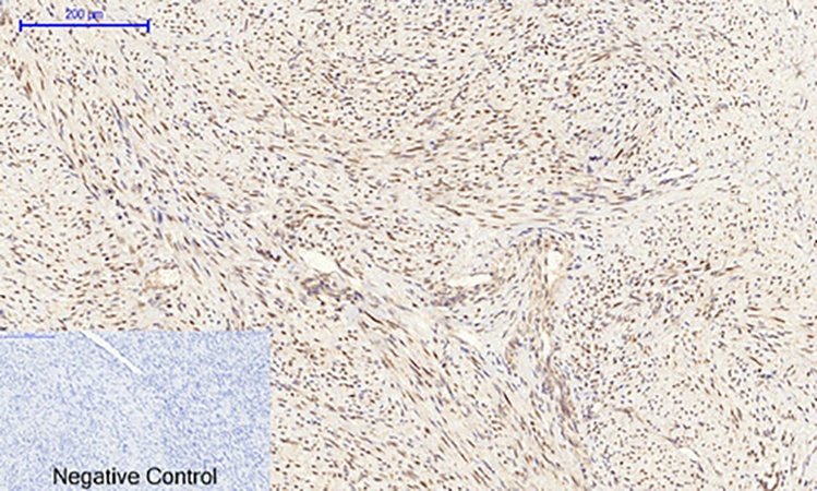 Fig.3. Immunohistochemical analysis of paraffin-embedded human uterus cancer tissue. 1, C/EBP β Polyclonal Antibody was diluted at 1:200 (4°C, overnight). 2, Sodium citrate pH 6.0 was used for antibody retrieval (>98°C, 20min). 3, secondary antibody was diluted at 1:200 (room temperature, 30min). Negative control was used by secondary antibody only.