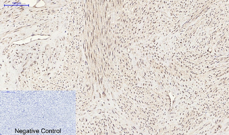 Fig.3. Immunohistochemical analysis of paraffin-embedded human uterus tissue. 1, PDGF-B Polyclonal Antibody was diluted at 1:200 (4°C, overnight). 2, Sodium citrate pH 6.0 was used for antibody retrieval (>98°C, 20min). 3, secondary antibody was diluted at 1:200 (room temperature, 30min). Negative control was used by secondary antibody only.