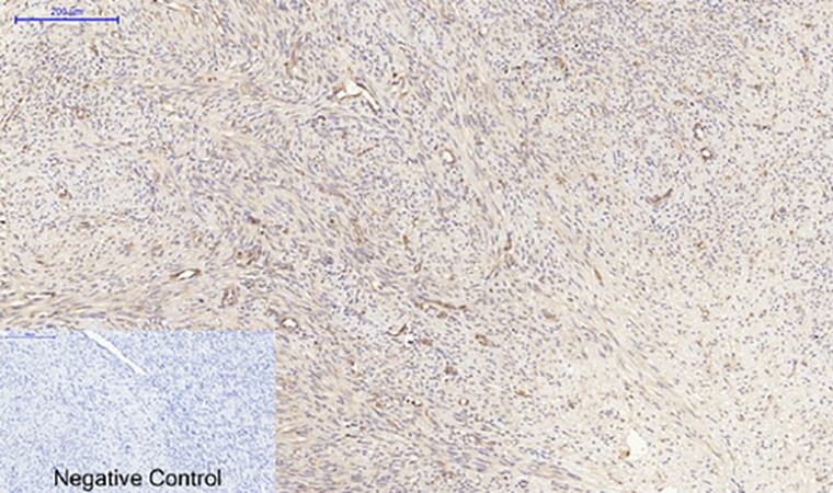 Fig.4. Immunohistochemical analysis of paraffin-embedded human uterus cancer tissue. 1, PPAR-α Polyclonal Antibody was diluted at 1:200 (4°C, overnight). 2, Sodium citrate pH 6.0 was used for antibody retrieval (>98°C, 20min). 3, secondary antibody was diluted at 1:200 (room temperature, 30min). Negative control was used by secondary antibody only.