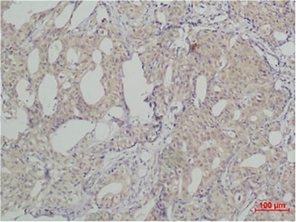 Fig.1. Immunohistochemical analysis of paraffin-embedded human breast caricnoma using SLUG Polyclonal Antibody.