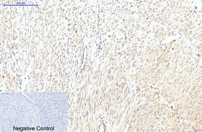 Fig.3. Immunohistochemical analysis of paraffin-embedded human uterus cancer tissue. 1, LC3B Polyclonal Antibody was diluted at 1:200 (4°C, overnight). 2, Sodium citrate pH 6.0 was used for antibody retrieval (>98°C, 20min). 3, secondary antibody was diluted at 1:200 (room temperature, 30min). Negative control was used by secondary antibody only.