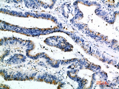 Fig.3. Immunohistochemical analysis of paraffin-embedded human-colon-cancer, antibody was diluted at 1:200.