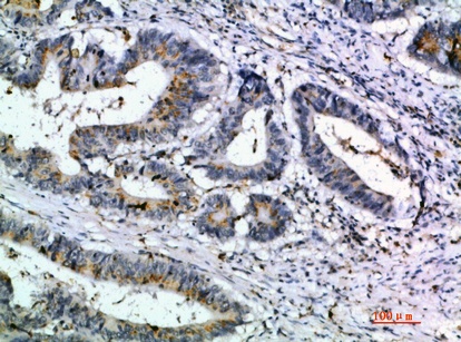 Fig.4. Immunohistochemical analysis of paraffin-embedded human-colon-cancer, antibody was diluted at 1:200.