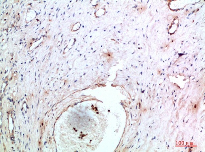 Fig.1. Immunohistochemical analysis of paraffin-embedded human-cervical-cancer, antibody was diluted at 1:200.