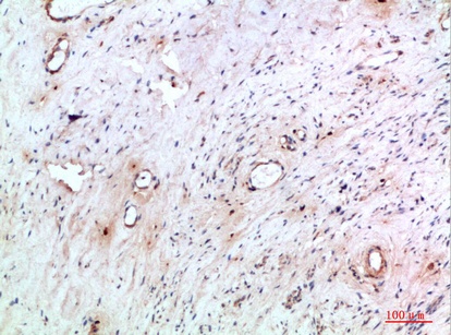 Fig.2. Immunohistochemical analysis of paraffin-embedded human-cervical-cancer, antibody was diluted at 1:200.