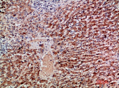 Fig.2. Immunohistochemical analysis of paraffin-embedded human-liver-cancer, antibody was diluted at 1:200.