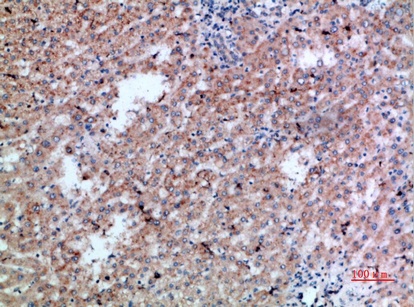 Fig.1. Immunohistochemical analysis of paraffin-embedded human-liver-cancer, antibody was diluted at 1:200.