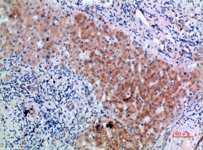 Fig.2. Immunohistochemical analysis of paraffin-embedded human-liver-cancer, antibody was diluted at 1:200.