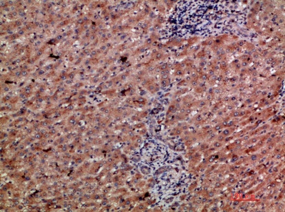 Fig.1. Immunohistochemical analysis of paraffin-embedded human-liver-cancer, antibody was diluted at 1:200.