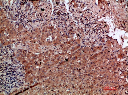 Fig.2. Immunohistochemical analysis of paraffin-embedded human-liver-cancer, antibody was diluted at 1:200.