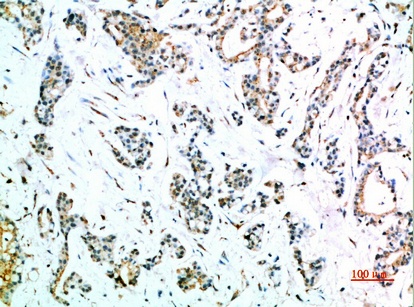 Fig.2. Immunohistochemical analysis of paraffin-embedded human-stomach-cancer, antibody was diluted at 1:200.