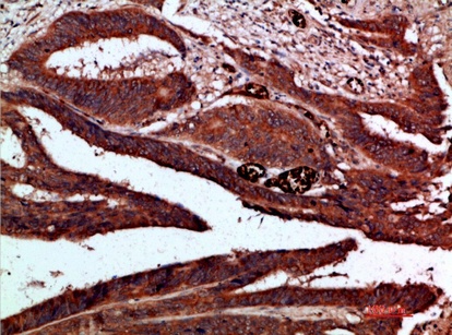 Fig.4. Immunohistochemical analysis of paraffin-embedded human-colon-cancer, antibody was diluted at 1:200.