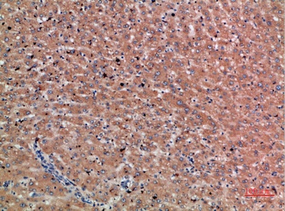 Fig.1. Immunohistochemical analysis of paraffin-embedded human-liver-cancer, antibody was diluted at 1:200.