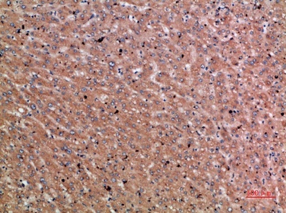 Fig.2. Immunohistochemical analysis of paraffin-embedded human-liver-cancer, antibody was diluted at 1:200.