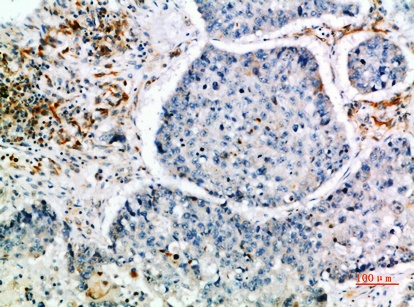 Fig.1. Immunohistochemical analysis of paraffin-embedded human-lung-cancer, antibody was diluted at 1:200.