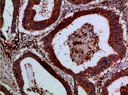 Fig.1. Immunohistochemical analysis of paraffin-embedded Human-colon-cancer, antibody was diluted at 1:100.